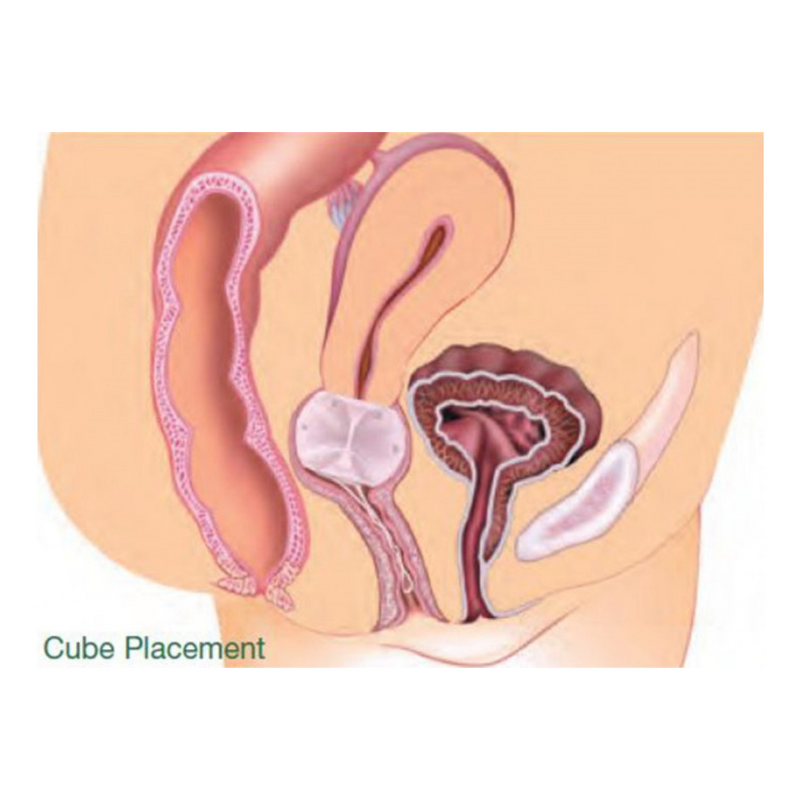 Kit pessaire Gyn&Cube en silicone