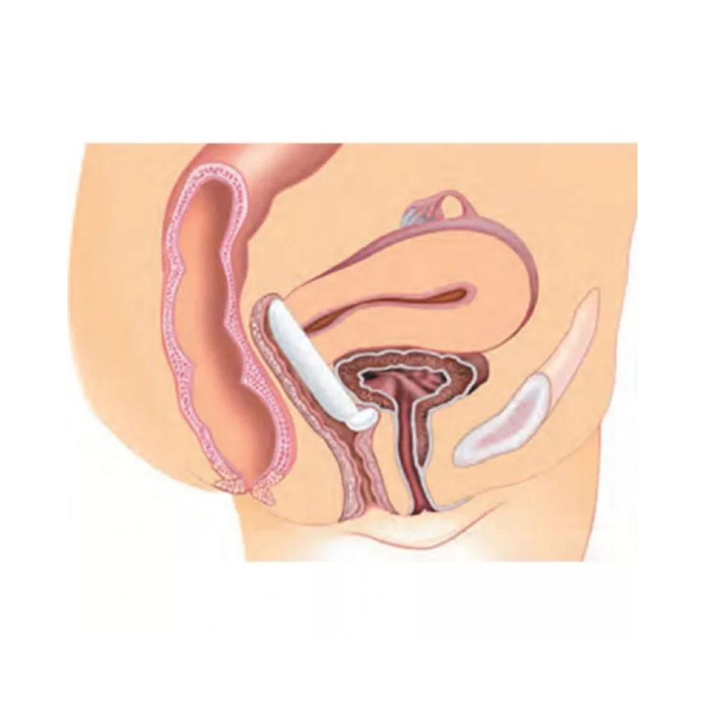 Pessaire silicone Gyn&Dish avec bouton