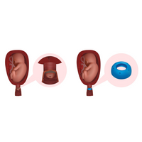 Pessaire de cerclage ASQ perforé Dr Arabin