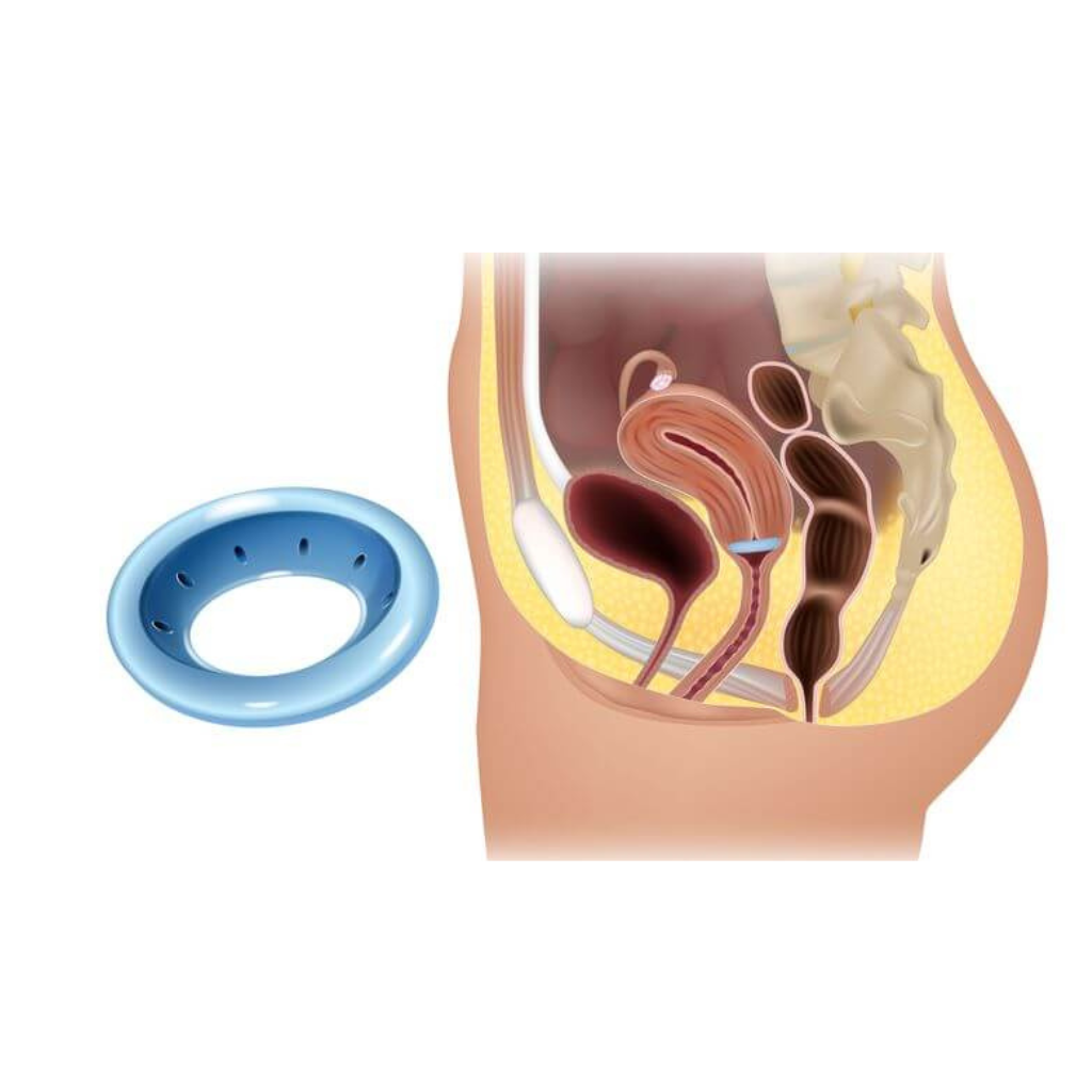 Pessaire de cerclage ASQ perforé Dr Arabin