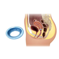 Pessaire de cerclage ASQ perforé Dr Arabin