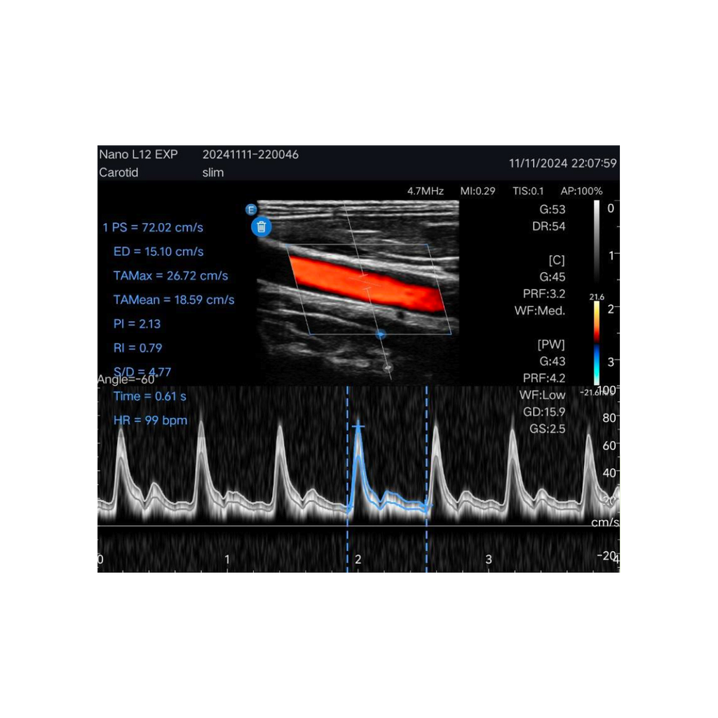 Echographe couleur portable Edan Nano linéaire