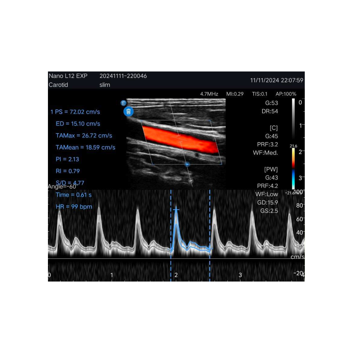 Echographe couleur portable Edan Nano linéaire