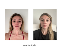 Dermaroller microneedling et son nettoyant Roller Cleaner