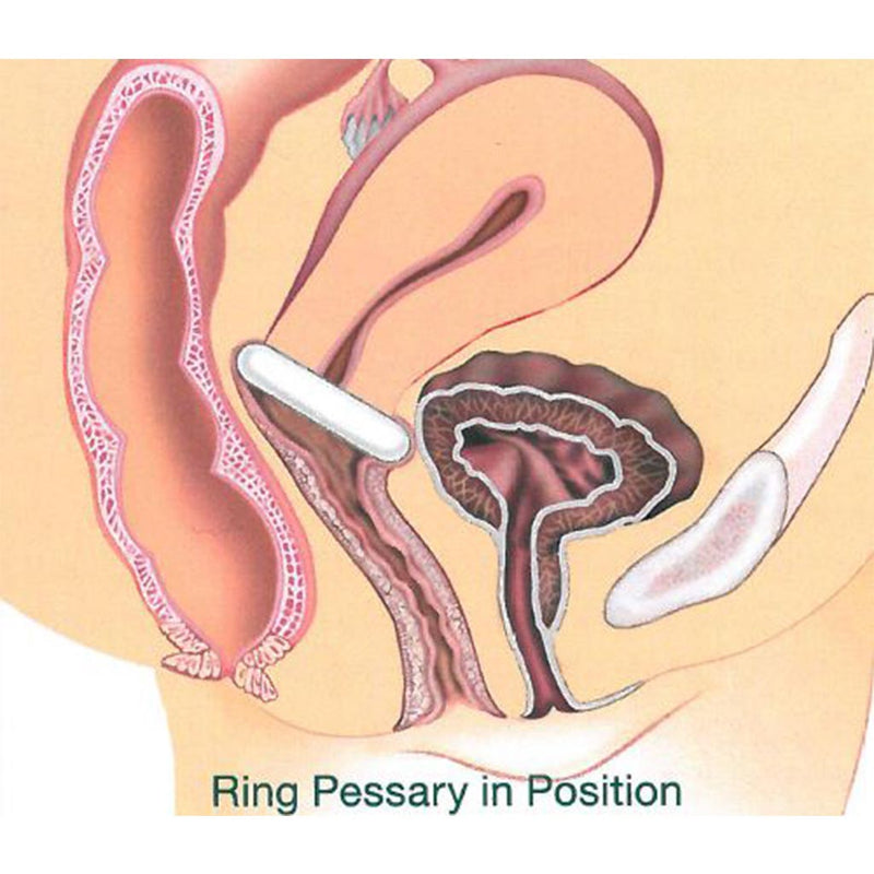 Pessaire Gyn&Ring sans support